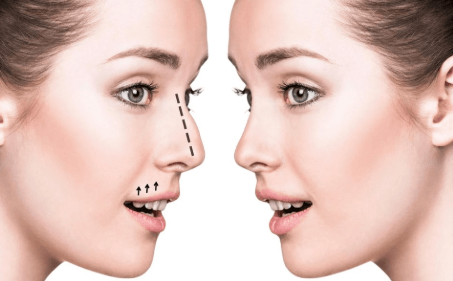 Nose Job